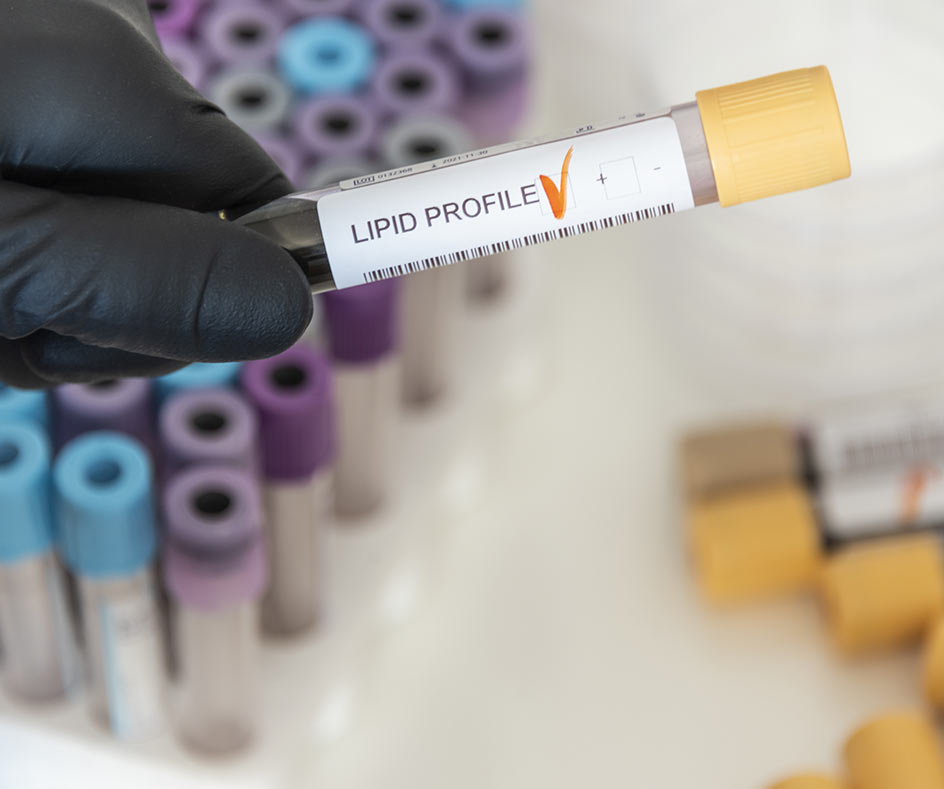 Full Lipid profile Blood Test in London