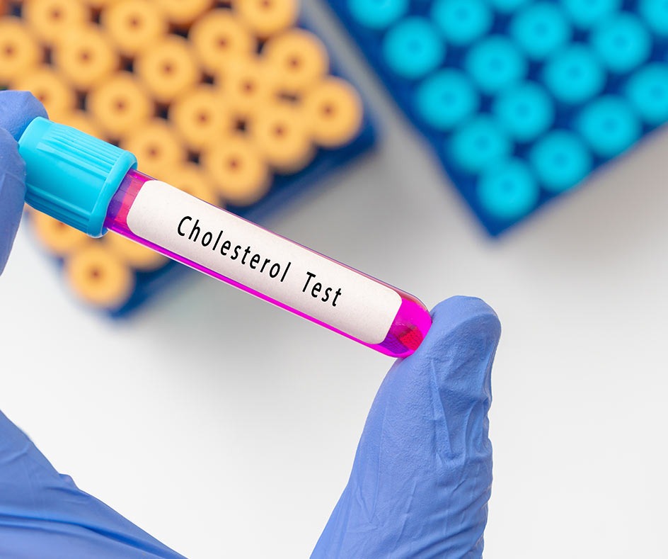 How our lipid profile blood test works