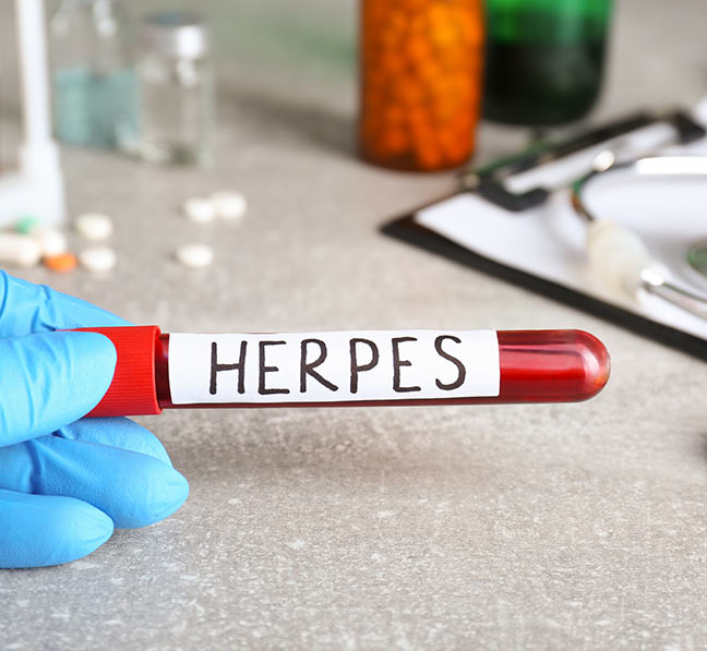 Cost of Private herpes testing