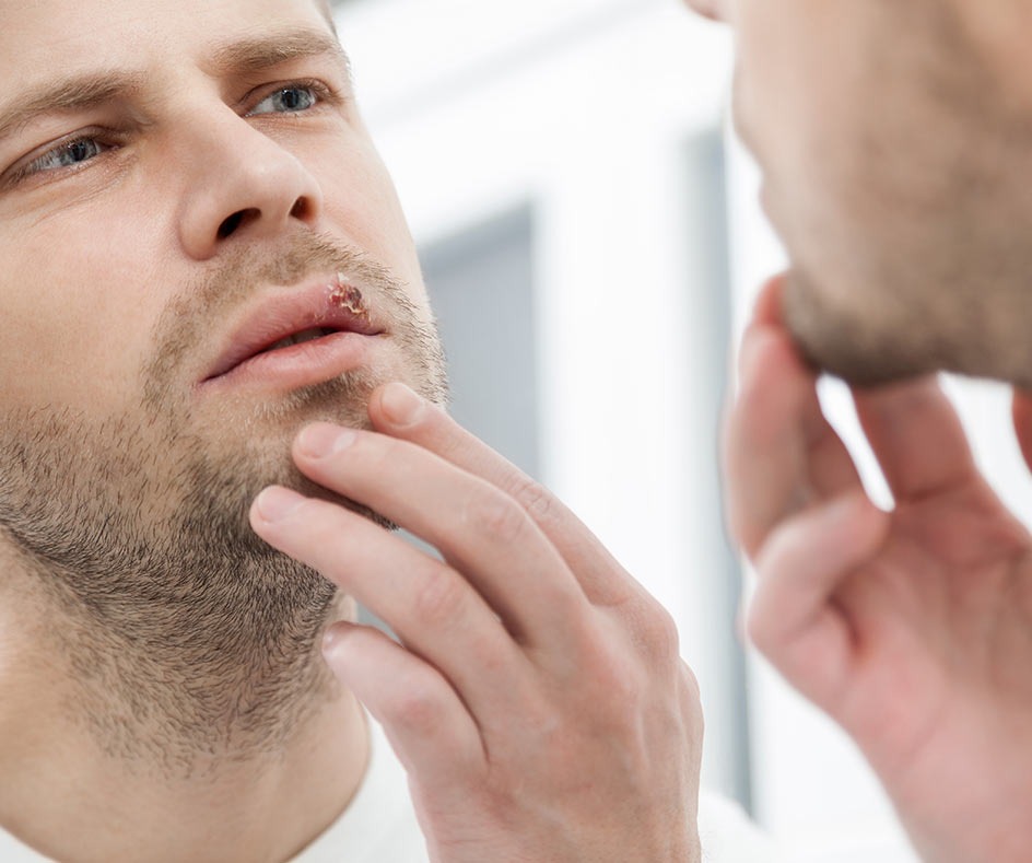 Genital herpes transmission