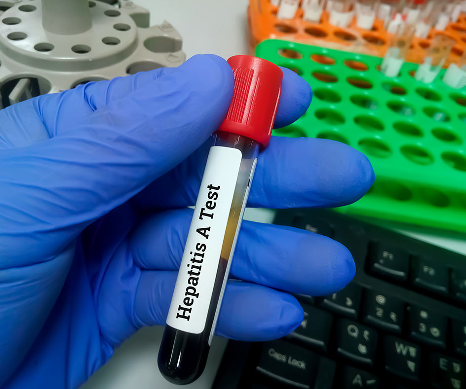 Hepatitis A test