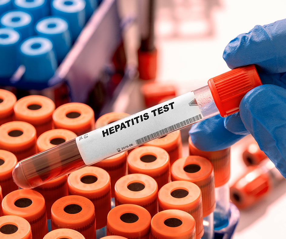 Hepatitis Blood Testing London