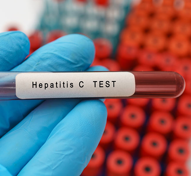 Hepatitis C symptoms