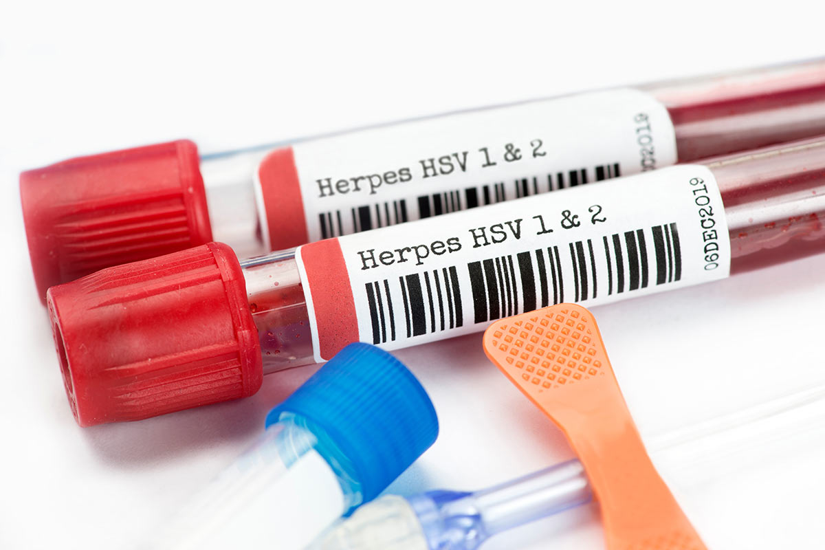 herpes blood tests