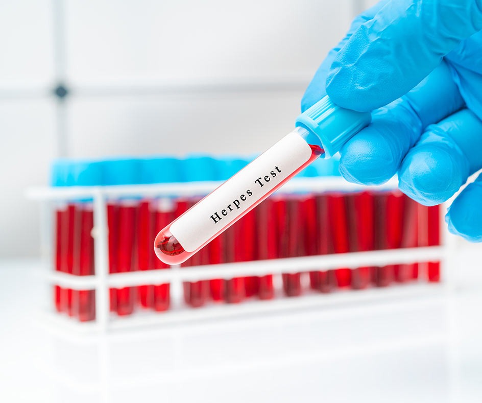 Herpes Testing London