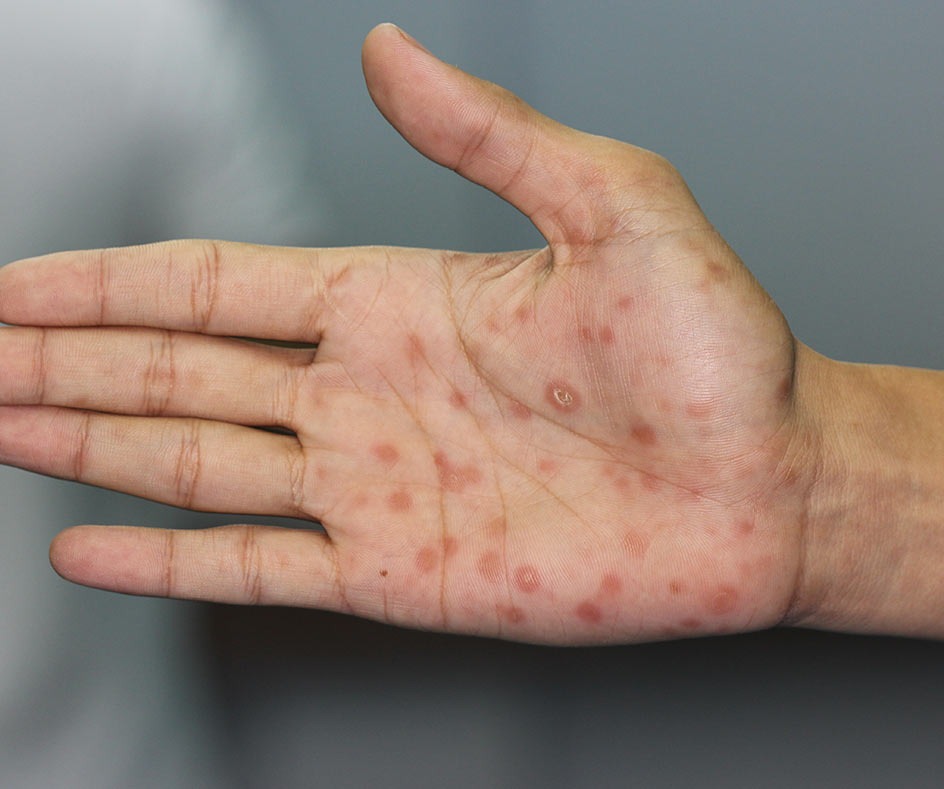 Syphilis Secondary stage